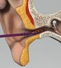 Picture of EarWay Pro M, 5,4mm, Purple- 25 Pack Size M